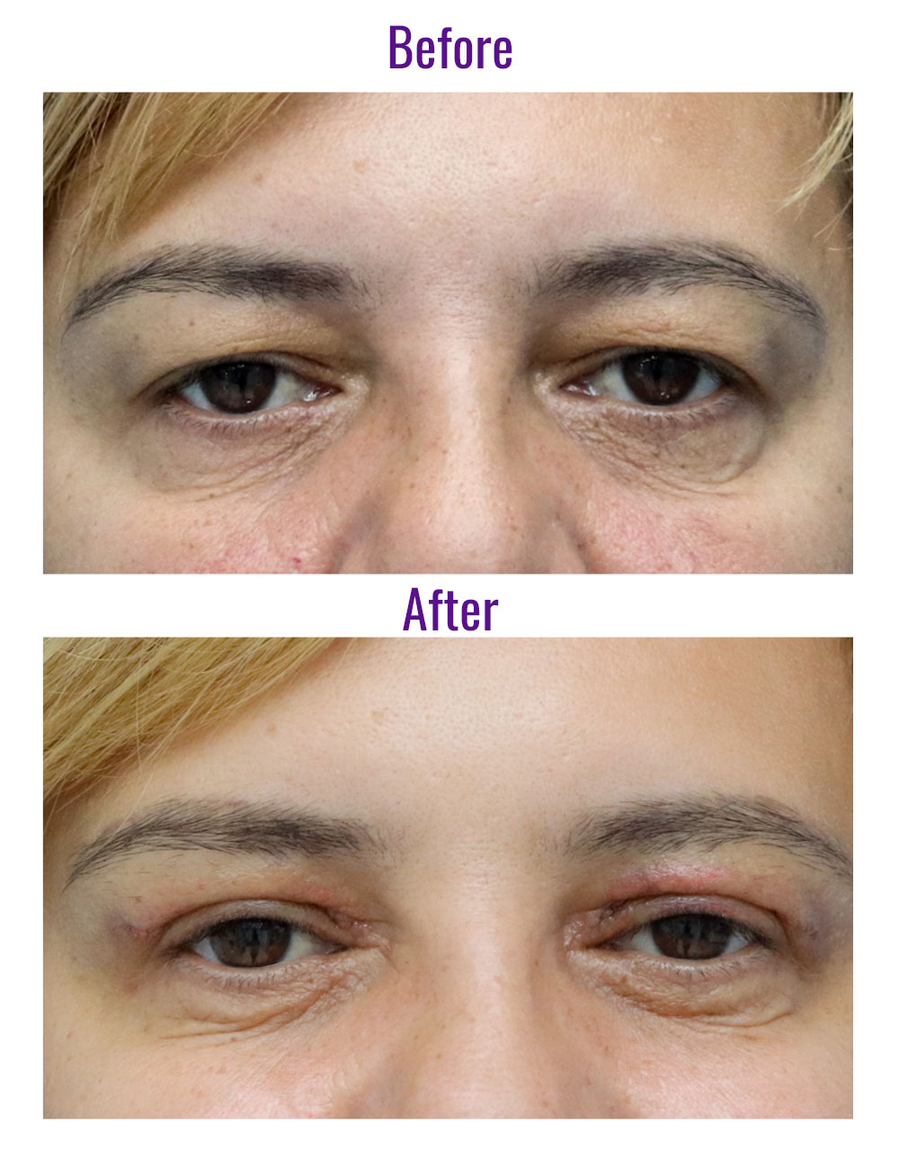Dr. Mihaela Dancaescu 5 before after mihaela dancaescu blefaro - cronosmed