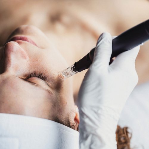 Facelift 7 microneedling at home doctor safta cronos med